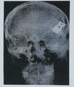 The Commissure Vol&nbsp;1