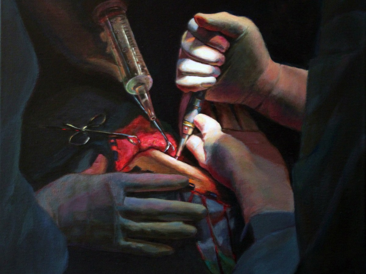 Craniotomy in G&nbsp;Sharp