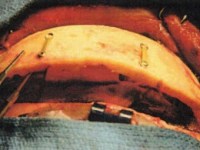 In Situ Hinge&nbsp;Craniectomy