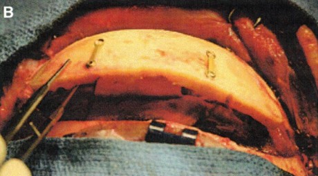 In Situ Hinge&nbsp;Craniectomy